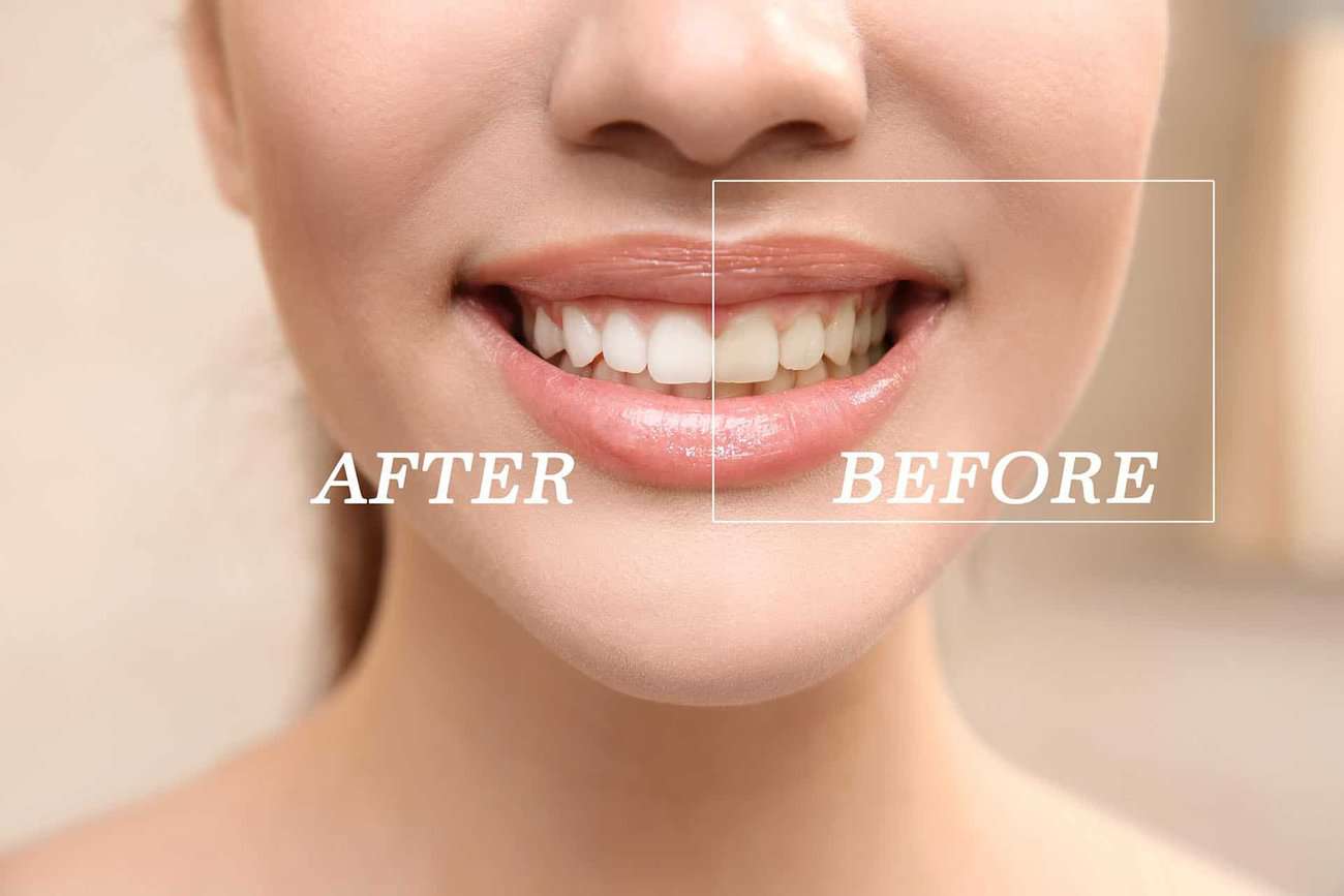 How Can You Maintain a Consistent Smile Shade with Crowns Shrewsbury?