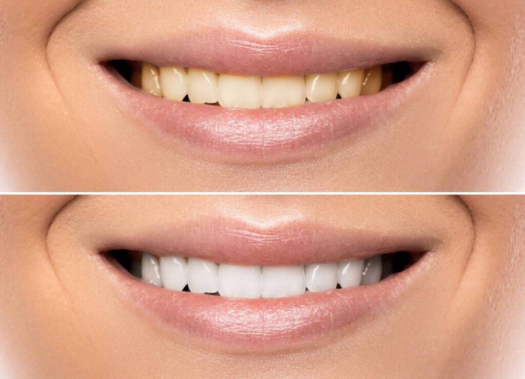 How Does Gum Disease Progress if Left Untreated Shrewsbury?
