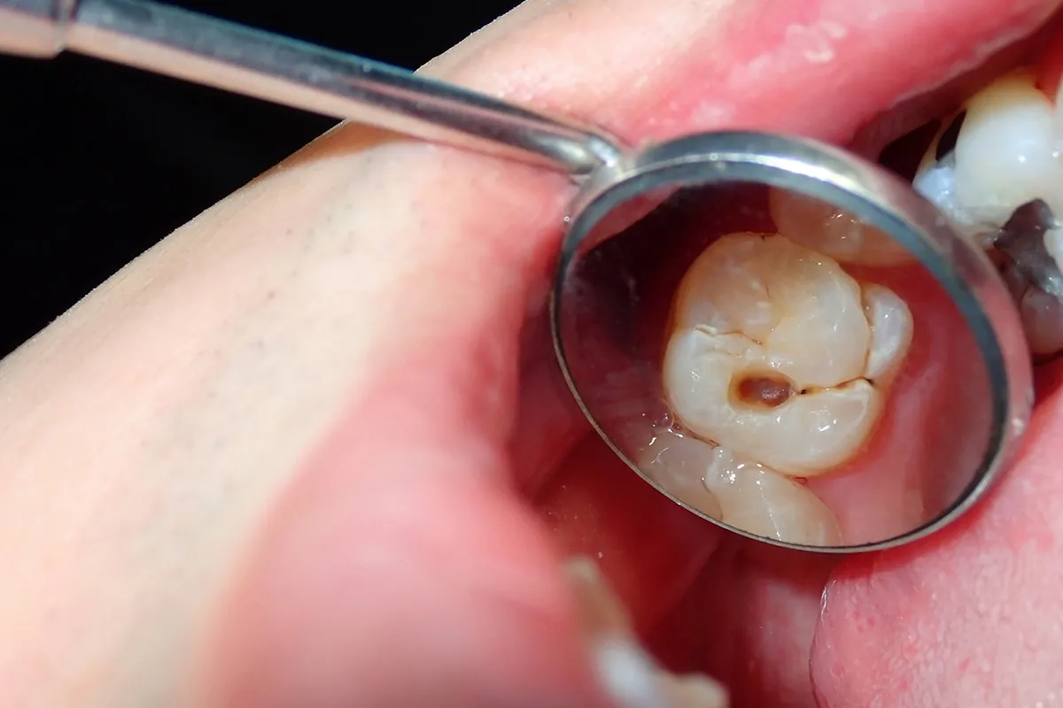 Why Do Teeth Crack? Common Causes to Know Shrewsbury