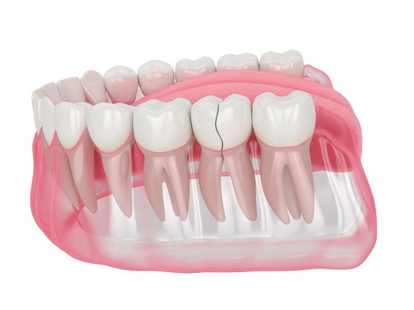 How Can You Manage Pain and Discomfort After a Root Canal Shrewsbury?