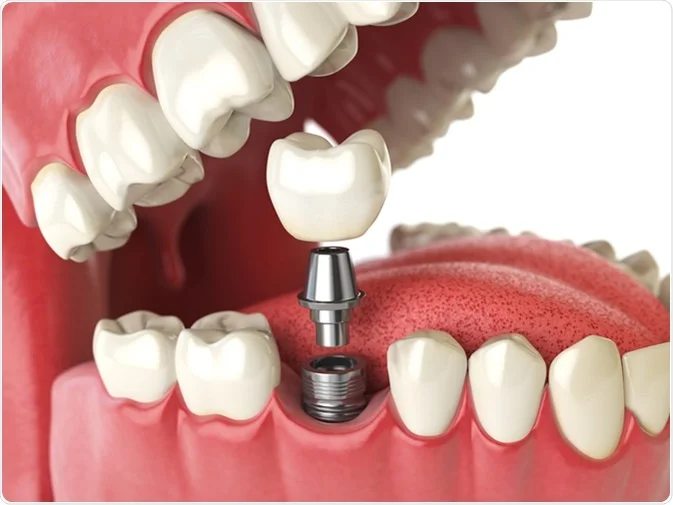 How Do I Decide Which Tooth Replacement Is Right for Me Shrewsbury?