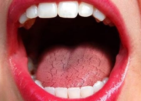 Common Causes of Dry Mouth (Xerostomia) Shrewsbury