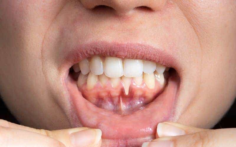 How Can Gum Disease Be Prevented Shrewsbury?