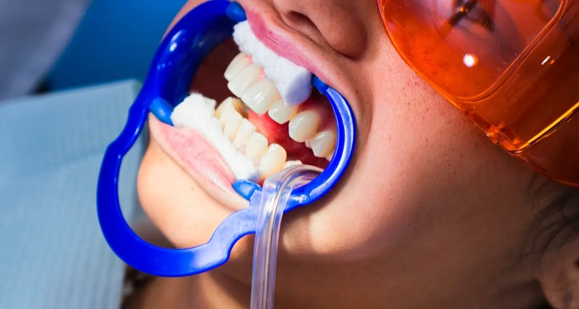 How Teeth Whitening Treatments Actually Work on Your Enamel Shrewsbury