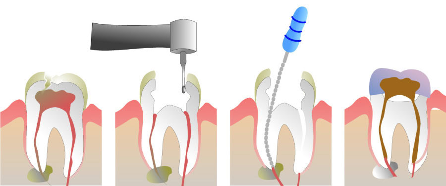 How Do You Properly Care for Your Teeth After a Root Canal Shrewsbury