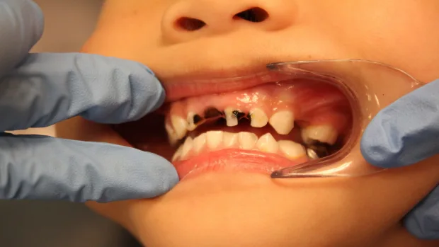 Tips for Keeping Your Child’s Baby Teeth Healthy and Strong Shrewsbury