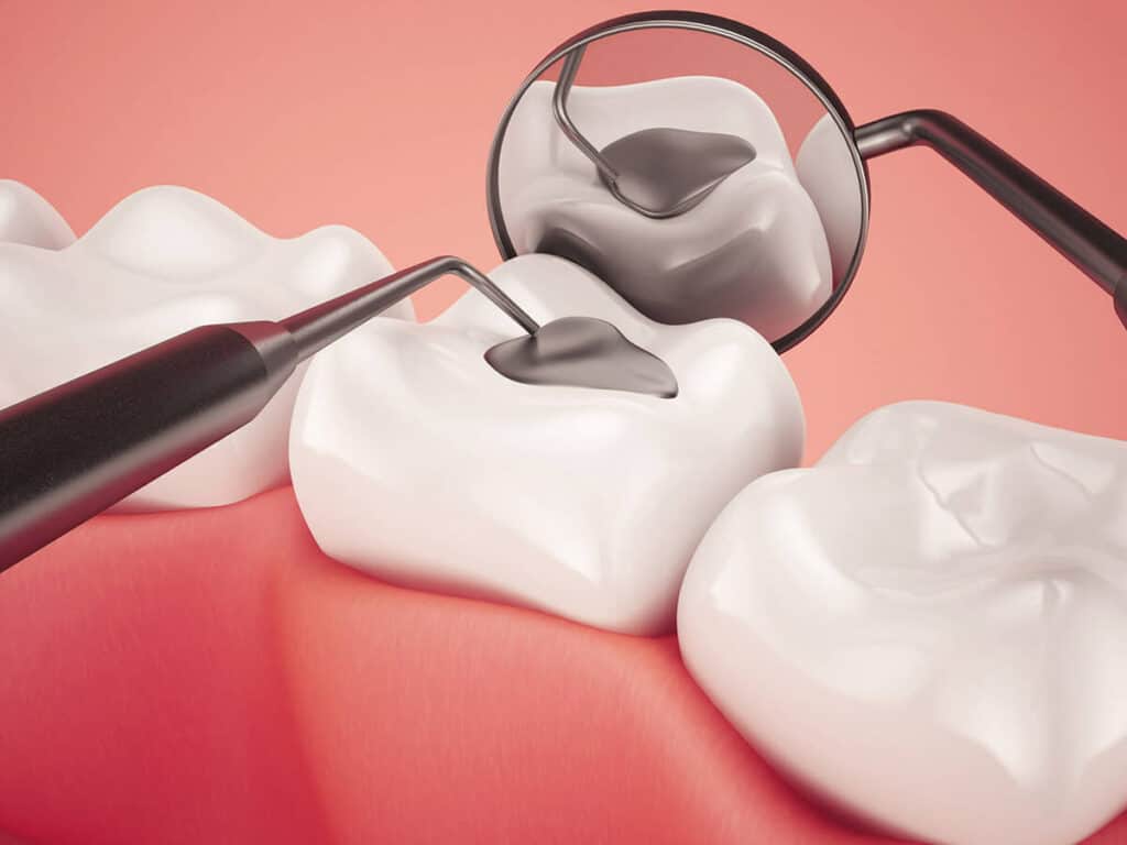 Fighting Cavities and Plaque Buildup Shrewsbury