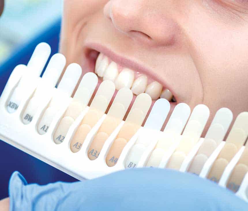 Professional vs At-Home Whitening: What You Need to Know Shrewsbury