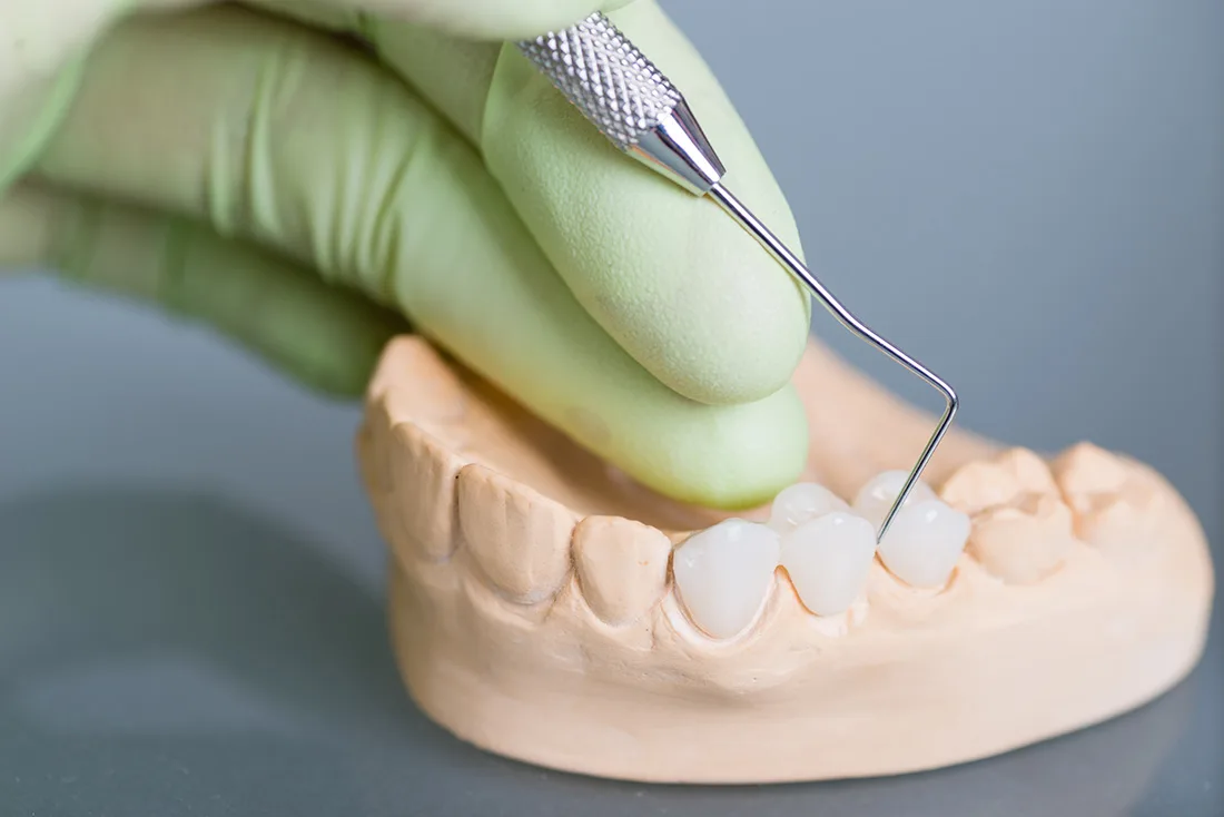 What Are the Different Types of Dental Crowns Available Shrewsbury?
