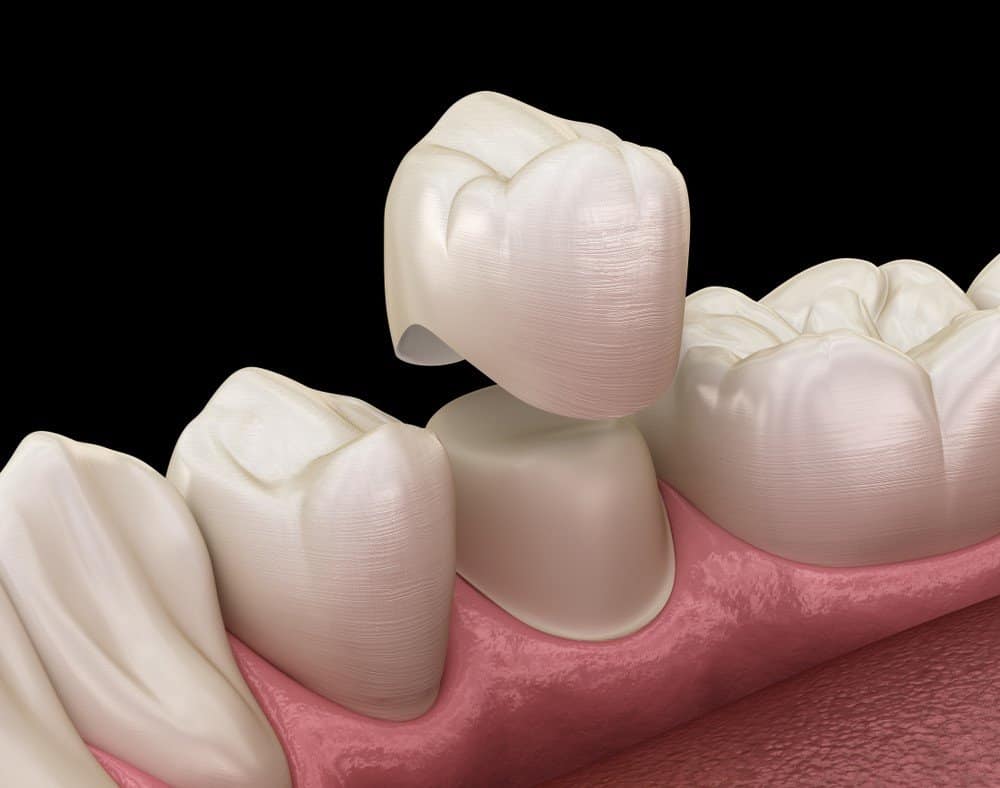 Teeth Whitening: Separating Facts from Fiction Shrewsbury